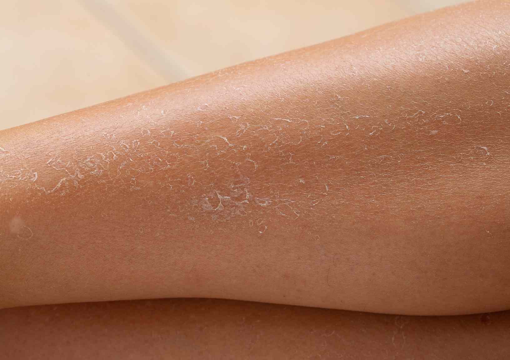 Pelle Secca Delle Gambe Cause Sintomi E Rimedi